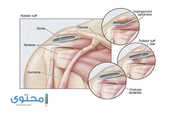أسباب وجود ألم في الكتف الأيسر من الخلف والأمام موقع محتوى