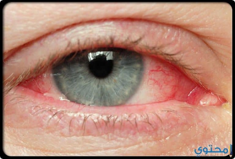 اسباب وطرق علاج احمرار العين والوقاية منه - موقع محتوى