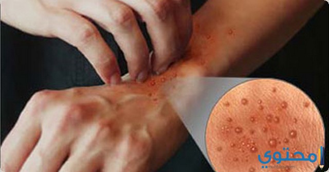 دواعي استخدام دواء ترايكوجيل
