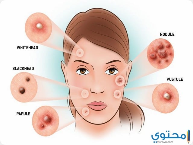 ديرما تي لعلاج حب الشباب Dermata T موقع محتوى