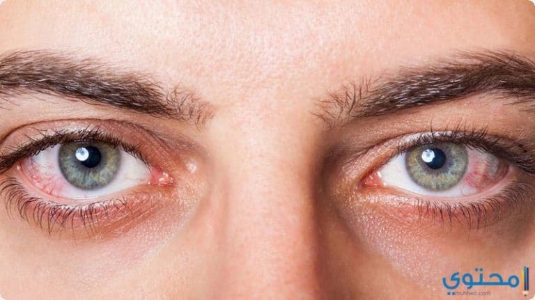 علاج احمرار العين في المنزل - موقع محتوى