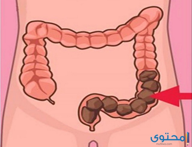 علاج الحرقة والألم التي تتبع خروج البراز موقع محتوى