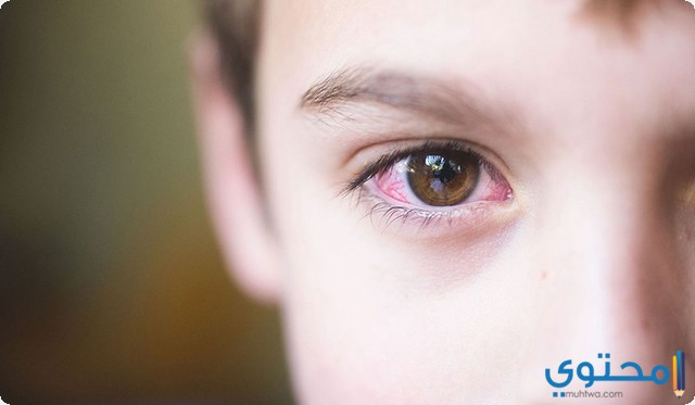 قطره لعلاج التهاب جفن العين عند الاطفال