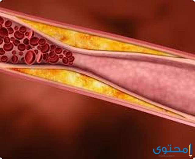 ما هو دواء كوليليسيس