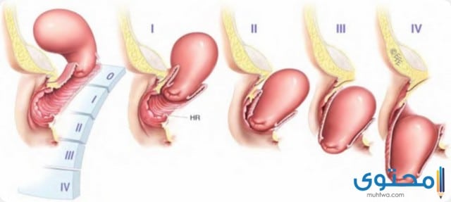 نزول الرحم اسبابه وعلاجه والوقاية منه موقع محتوى