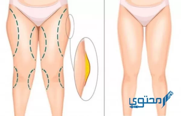 تجربتي مع عملية شد الأفخاذ والمؤخرة