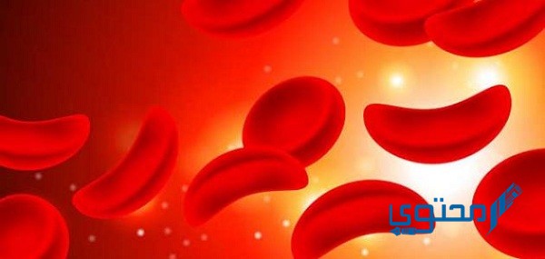 ما هو فقر الدم المنجلي