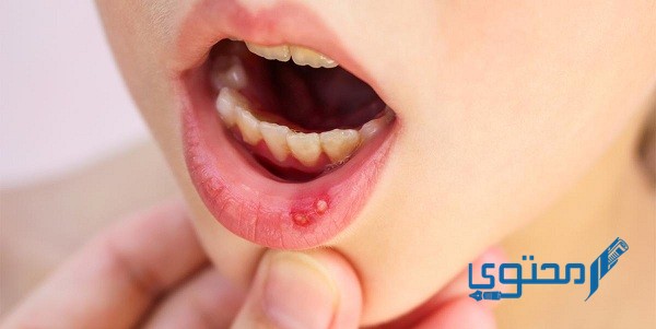 علاج تقرحات الفم بالملح 
