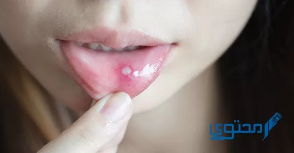 علاج تقرحات الفم بالملح 