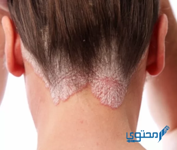 الأمراض الجلدية التي تصيب فروة الرأس بالتفصيل