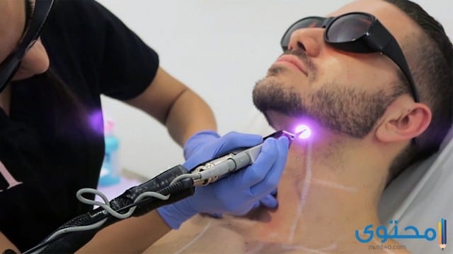 إزالة الشعر بالليزر