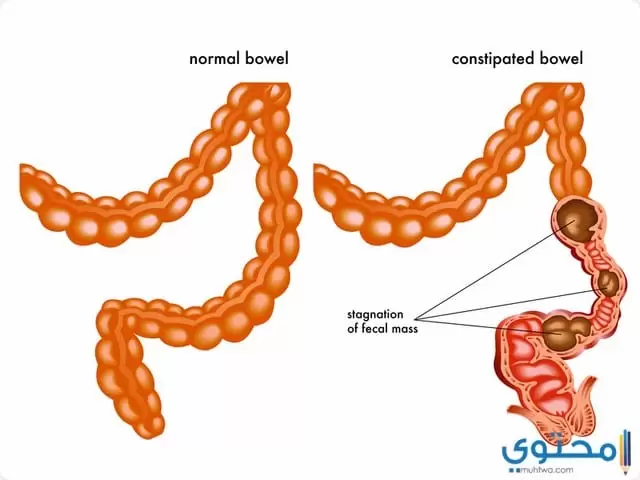 أسباب حدوث الإمساك