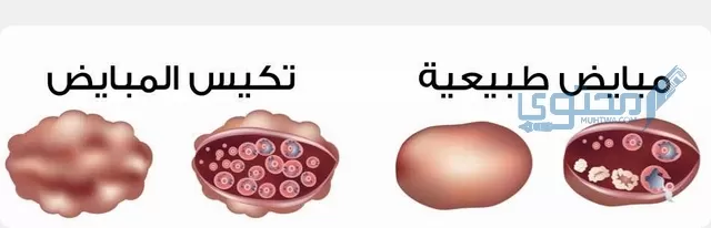 أشهر علامات تدل على تكيس المبايض