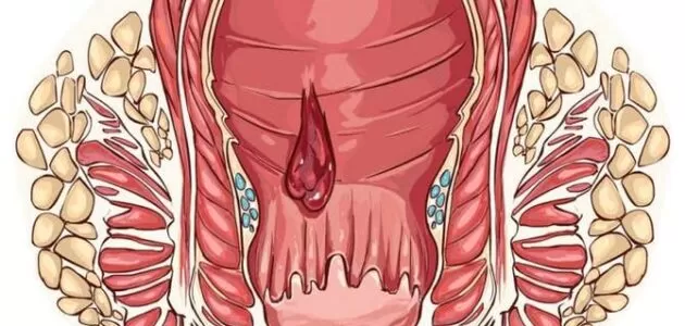 طرق علاج للبواسير