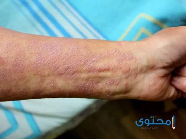 أمراض الجلد بالصور1