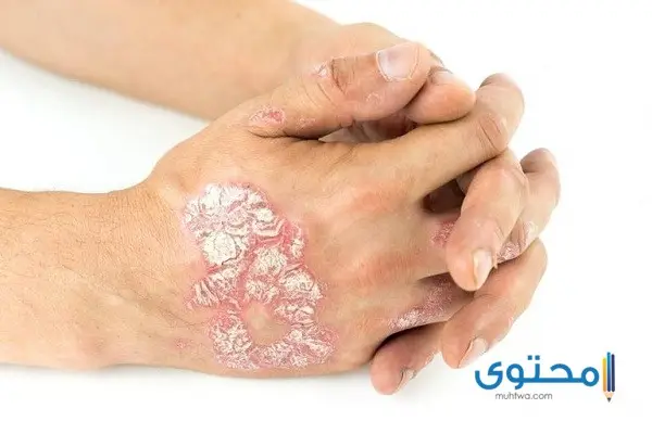 أمراض الجلد بالصور5