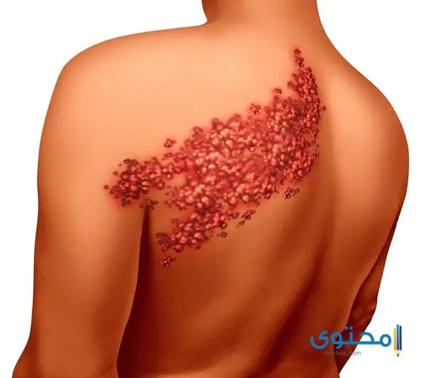 أمراض الجلد بالصور6
