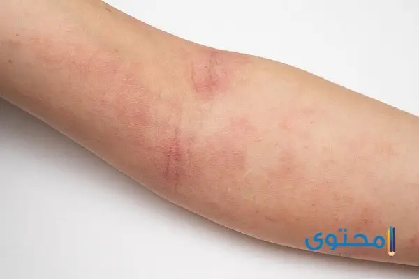 أمراض الجلد بالصور7