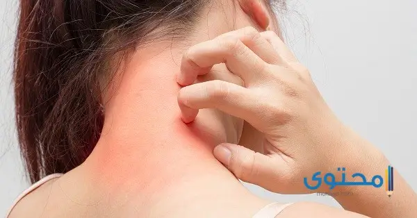 أمراض الجلد بالصور8