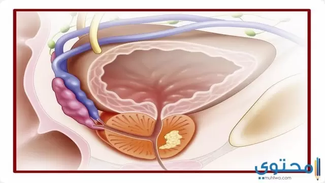 احتقان البروستاتا المزمن 03