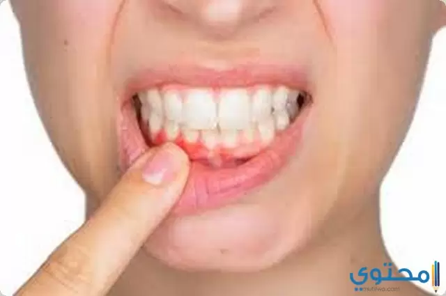 ادوية علاج التهاب اللثة والاسنان