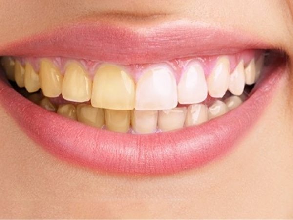 طرق التخلص من اصفرار الأسنان