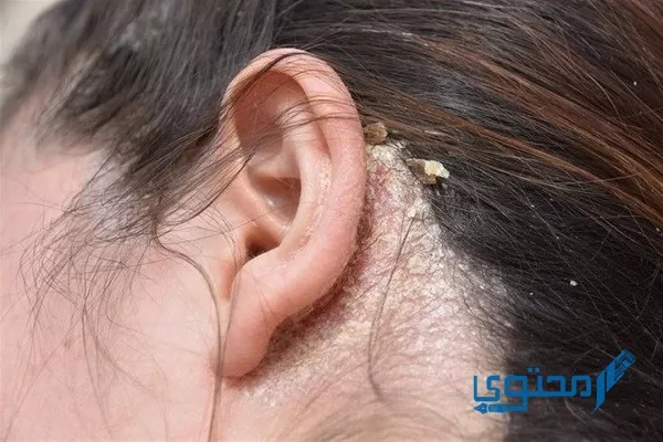 الأمراض الجلدية التي تصيب فروة الرأس بالتفصيل