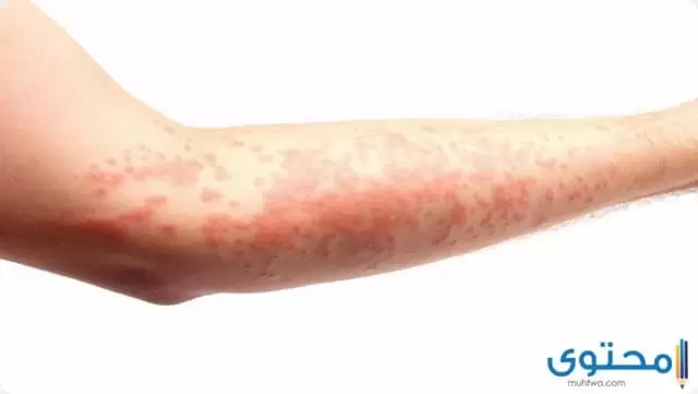 برينابول pernabol لعلاج الأمراض الجلدية