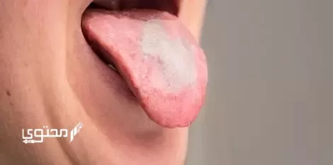 تجاربكم مع فطريات اللسان
