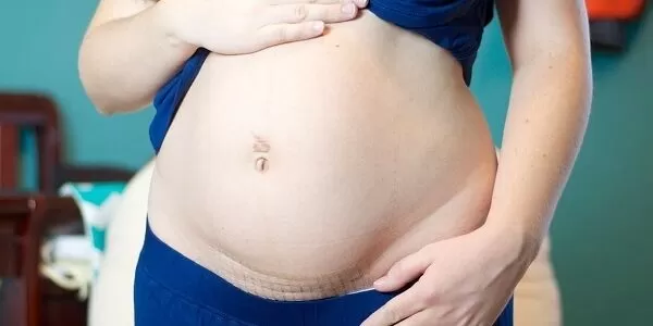 تجربتي في التخلص من الكرش بعد القيصرية