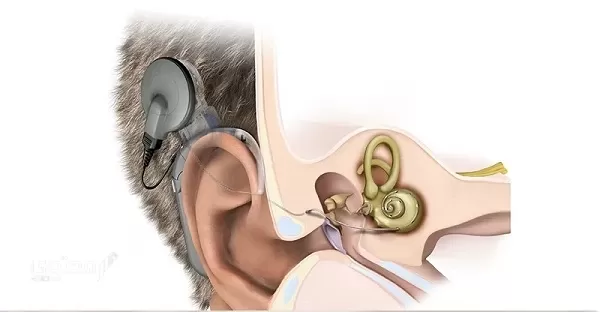 تجربتي في علاج ضعف السمع