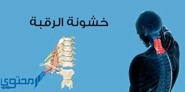 تجربتي مع خشونة الرقبة