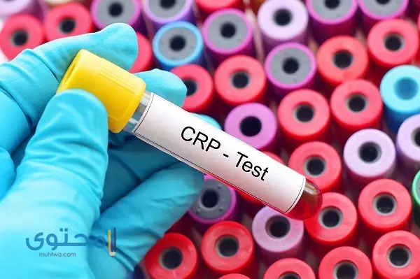 ما هو تحليل CRP ؟ (اختبار بروتين سي التفاعلي)