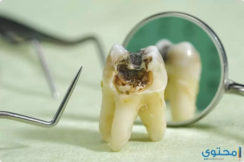 اسباب تسوس الأسنان وطرق علاجها