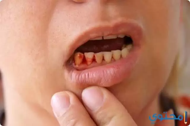 تفسير دم من الفم في المنام