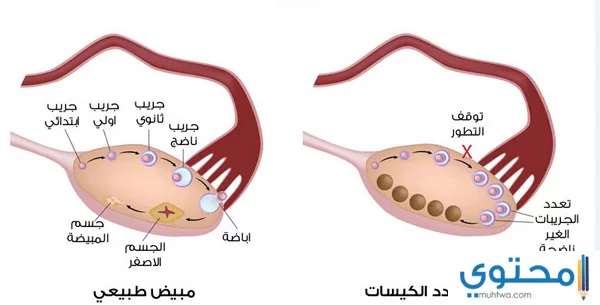 تكيس المبايض