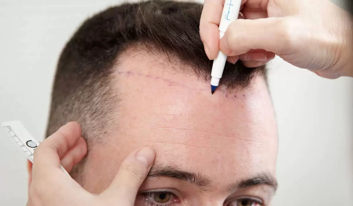 تفاصيل عملية زراعة الشعر بتقنية السفير