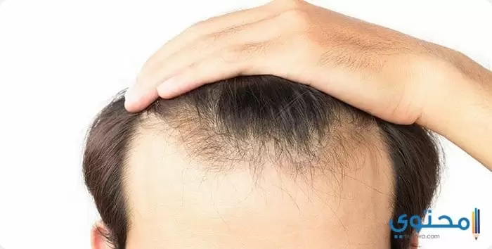 زراعة الشعر الطبيعي في الجزائر