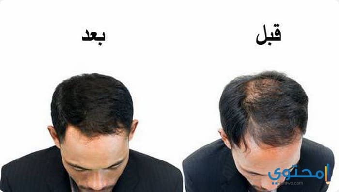 تكلفة زراعة الشعر فى مصر