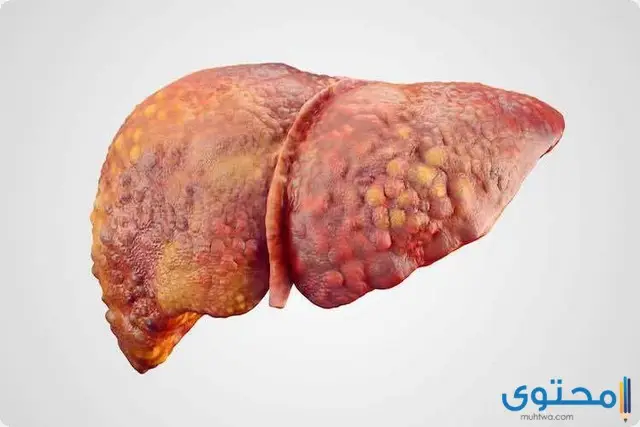 أعراض سرطان الكبد