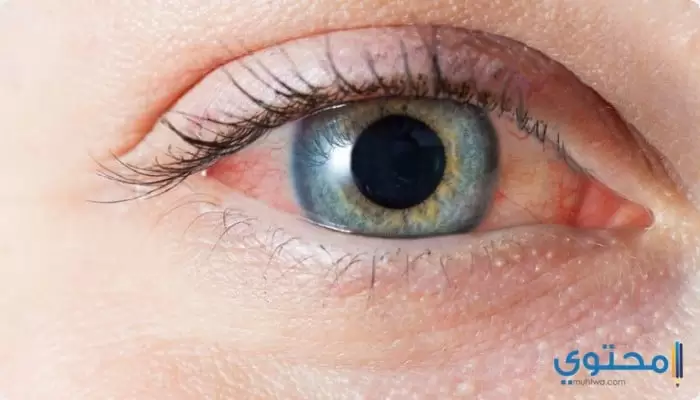 علاج أمراض العيون بالأعشاب