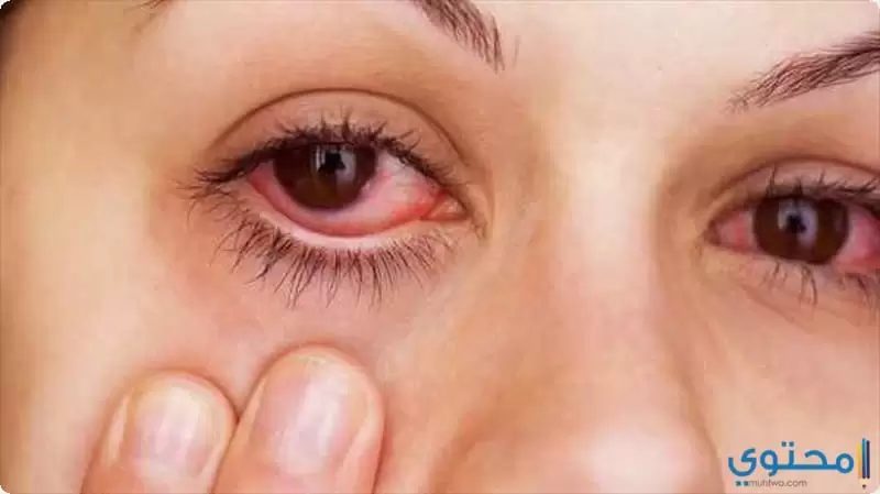علاج احمرار العين1