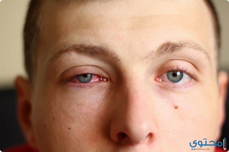 مسببات الاصابة باحمرار العين