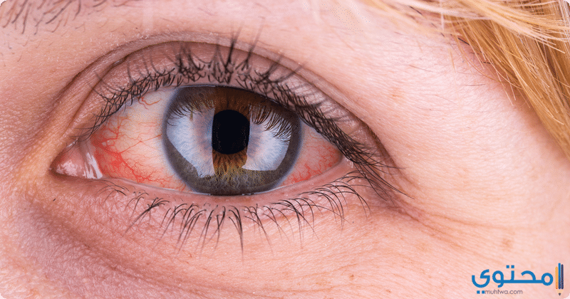 طرق علاج احمرار العين