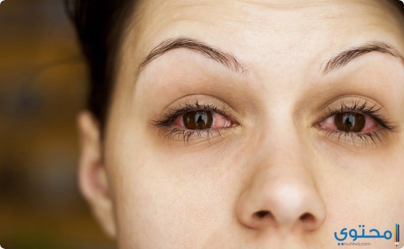 علاج احمرار العين طبيعيا