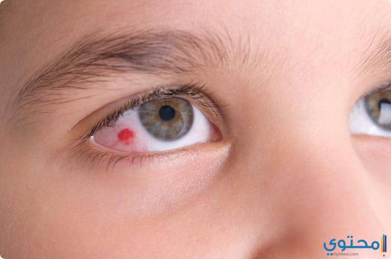 طرق علاج احمرار العين