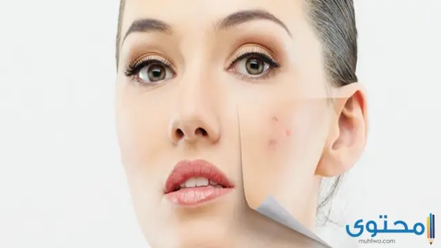 علاج البقع البنية في الوجه بالأدوية