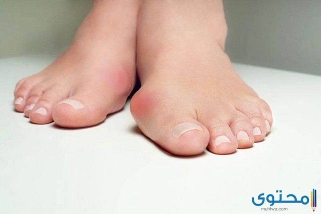 طرق علاج التهاب اصبع القدم الكبير