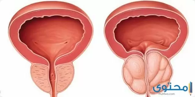 علاج البروستاتا بالأدوية