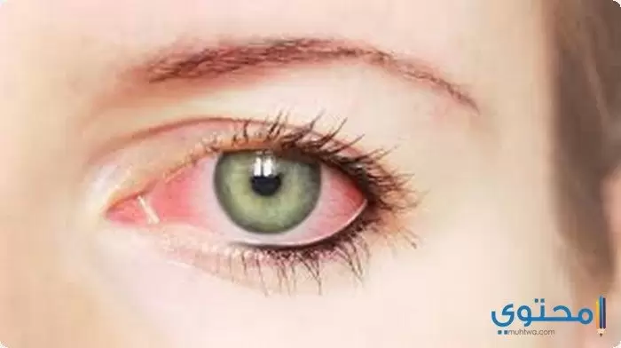 علاج التهاب العين بالأعشاب1